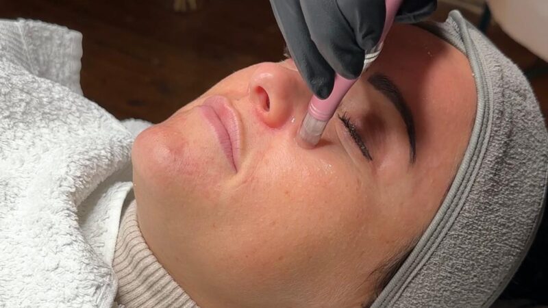 Microneedling Radebeul, Nicole-